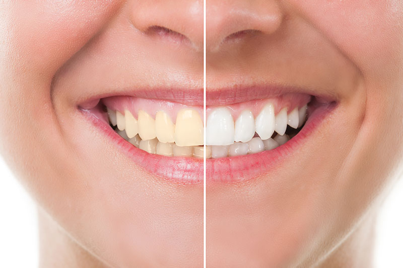 Teeth Whitening in Harrogate